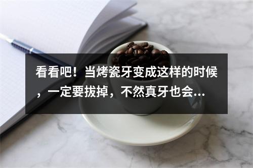 看看吧！当烤瓷牙变成这样的时候，一定要拔掉，不然真牙也会烂掉！